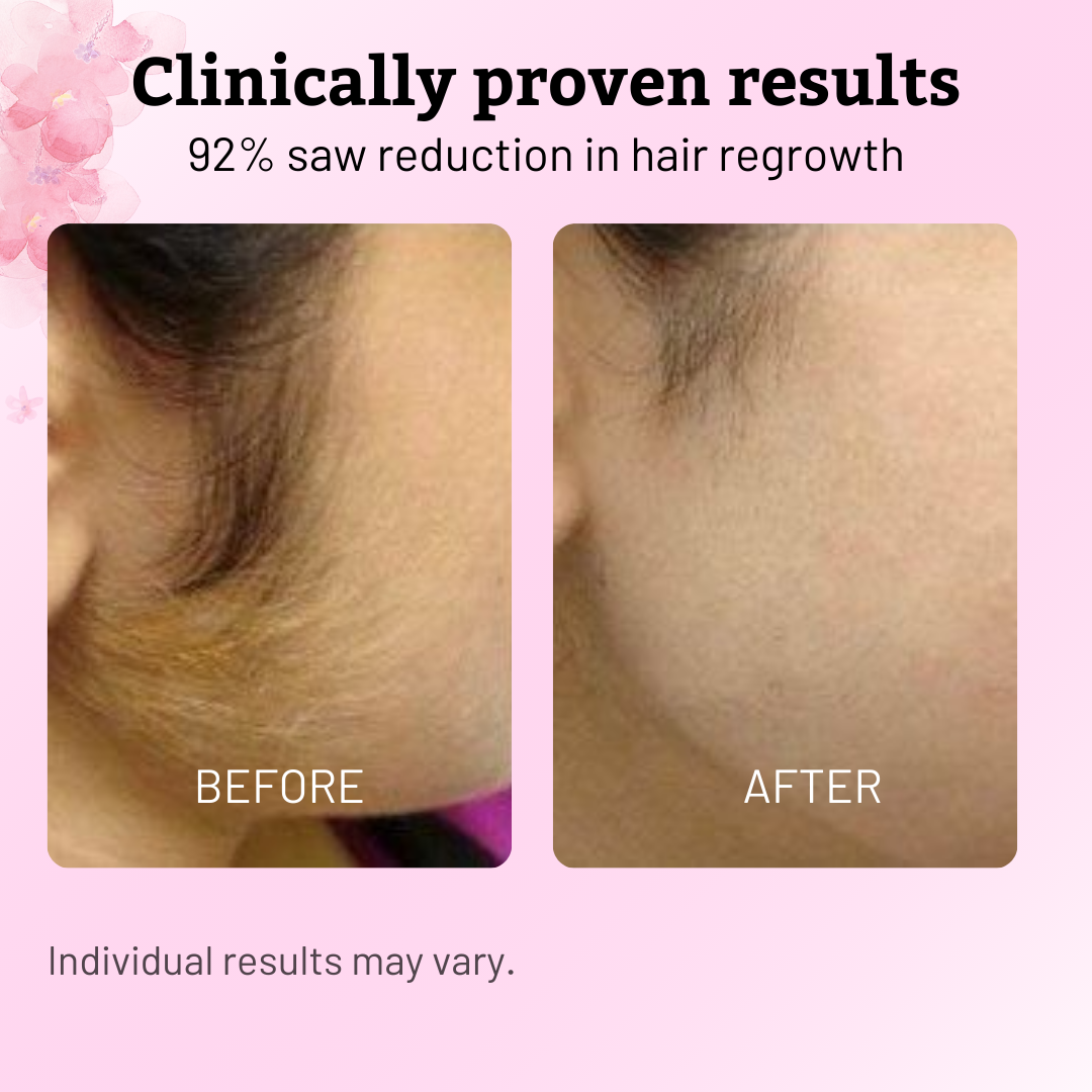 Cyperus Rotundus Oil for Natural Permanent Hair Reduction